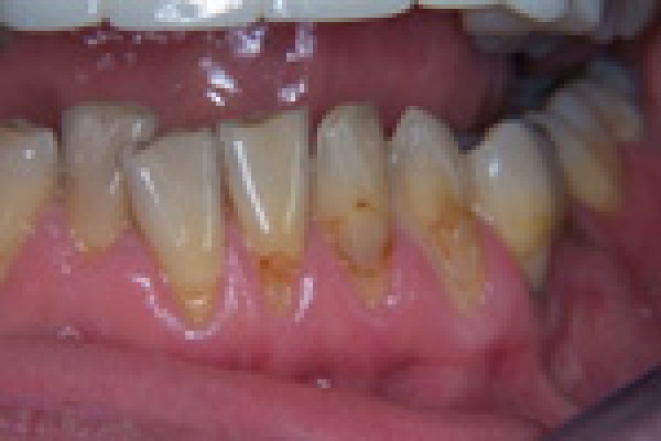 Transformation de la forme et de la couleur des dents, transformation des gencives et réalignement des dents