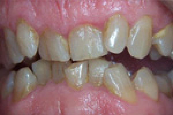 Cas du mois d'octobre - Réalignement des dents par des facettes
