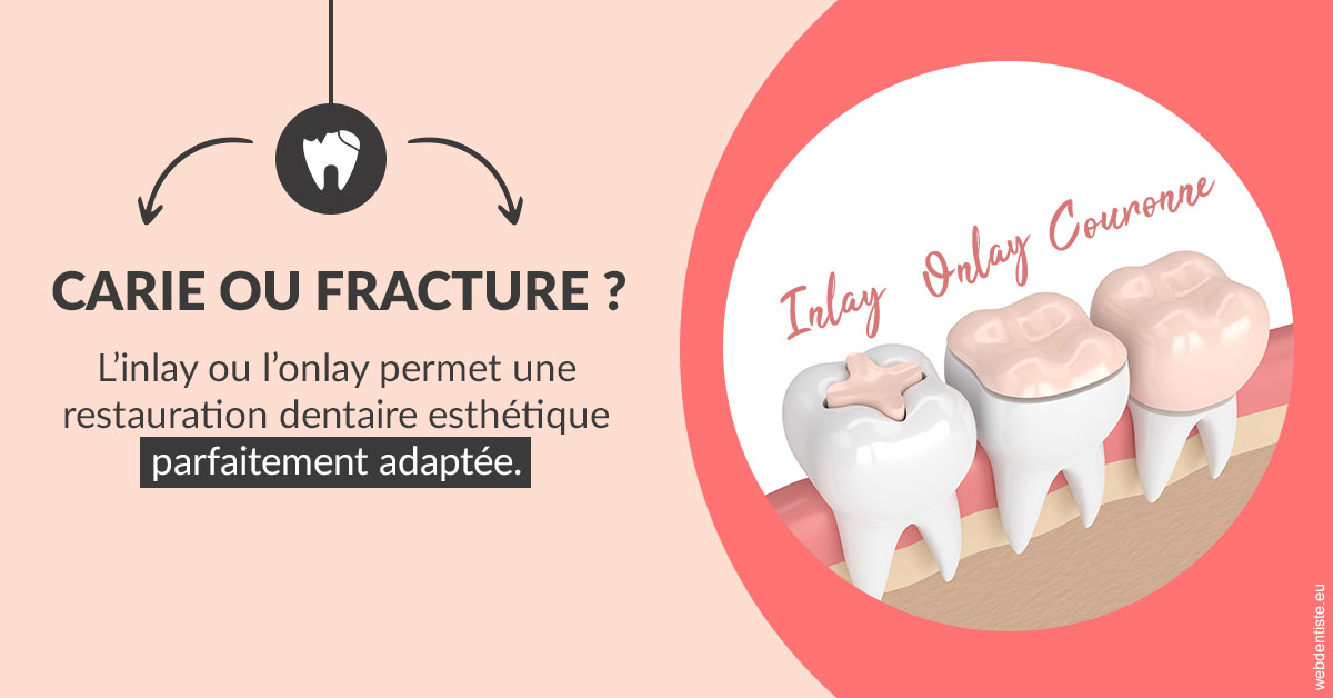 https://dr-nahon-jacques.chirurgiens-dentistes.fr/T2 2023 - Carie ou fracture 2