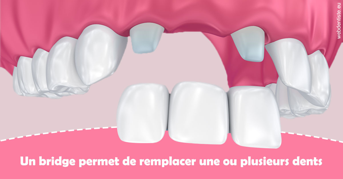 https://dr-nahon-jacques.chirurgiens-dentistes.fr/Bridge remplacer dents 2