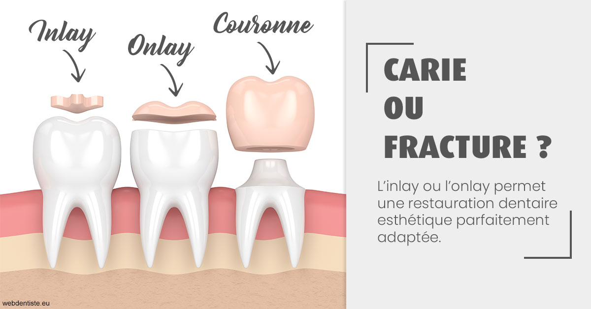 https://dr-nahon-jacques.chirurgiens-dentistes.fr/T2 2023 - Carie ou fracture 1