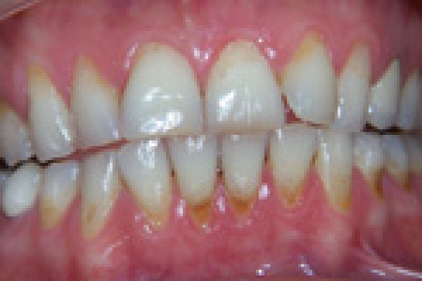 Remplacement d’un émail usé et très coloré par des facettes dentaires - Cas du mois de septembre 2015