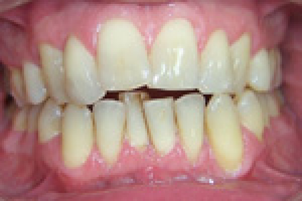 Réalignement des dents et teinte plus claire par la pose de facettes haut et bas - Cas du mois de mars 2016