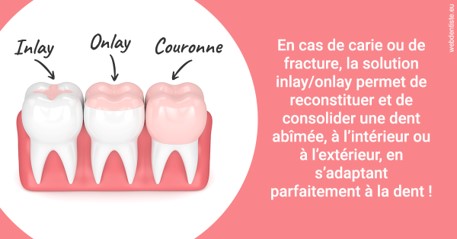 https://dr-nahon-jacques.chirurgiens-dentistes.fr/L'INLAY ou l'ONLAY 2