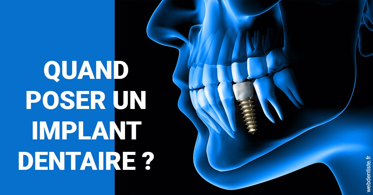 https://dr-nahon-jacques.chirurgiens-dentistes.fr/Les implants 1