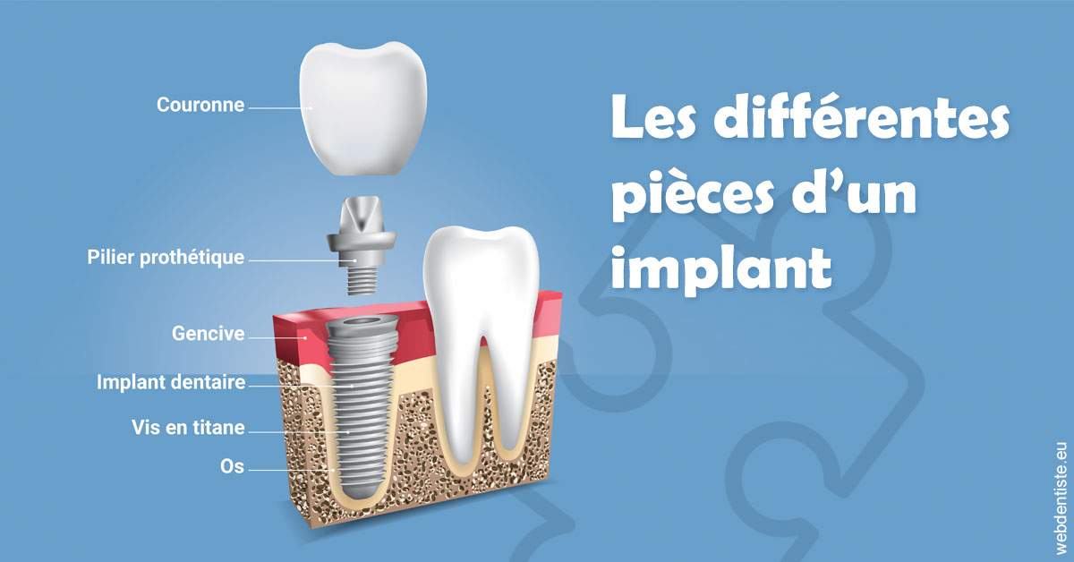 https://dr-nahon-jacques.chirurgiens-dentistes.fr/Les différentes pièces d’un implant 1